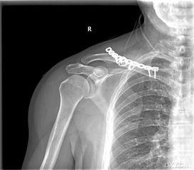 成人骨折塑形过程视频,视频解析与科学解读